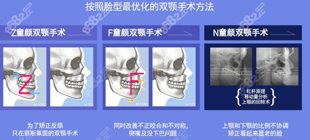 韓國(guó)smart雙鄂手術(shù)的全過(guò)程圖解