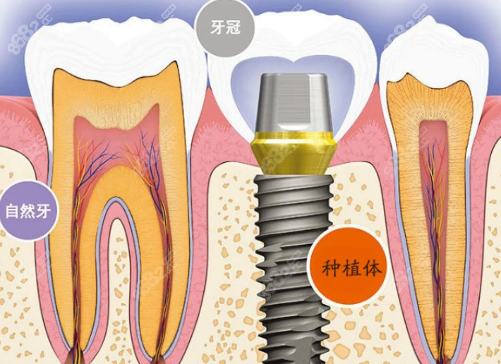 上海永华口腔种植牙价格
