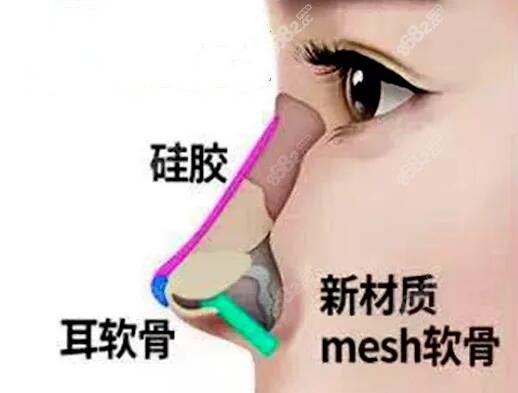 崔宰源医生做Mesh假体隆鼻手术www.8682.cc