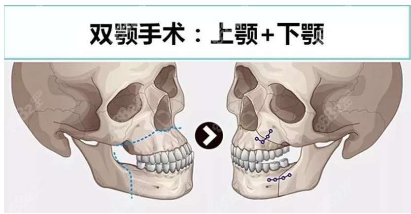 重庆松山医院正颌手术怎么样