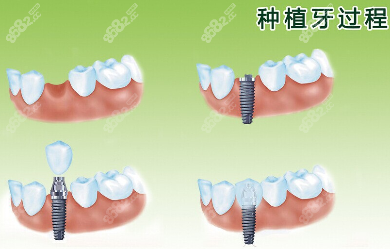 汕头种植牙过程
