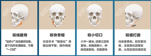 黄大勇做下颌角手术技术好