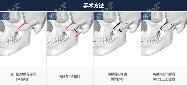 韩国GNG医院颧骨缩小手术方法