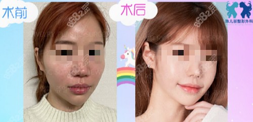 韩国珠儿丽全脸脂肪填充术前术后对比