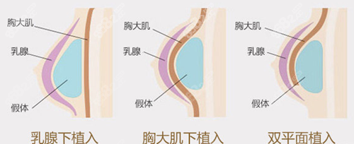 双平面植入方式