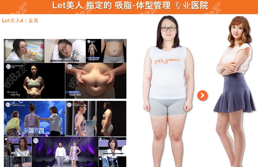 韓國365mc吸脂真人對(duì)比圖