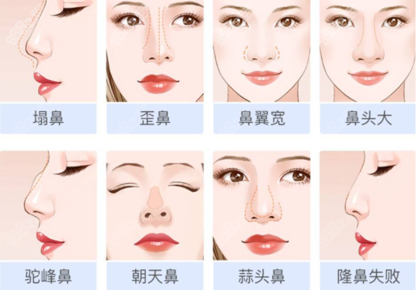 重庆松山医院鼻综合价格