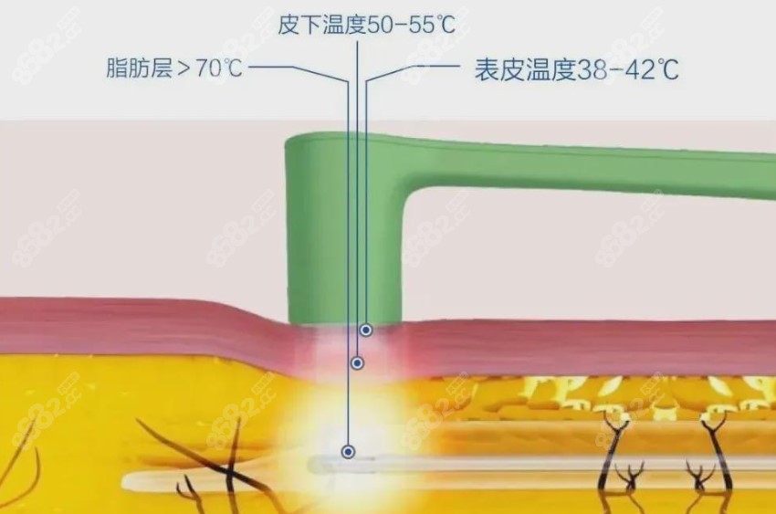 <!--<i data=20240705-sp></i>-->抽脂技术好