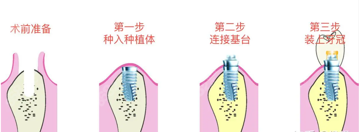芜湖美臣口腔种植牙过程和步骤
