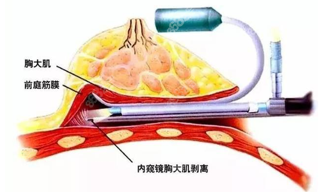 假体深V动感美胸价格实惠结果比较自然（m.8682.cc）