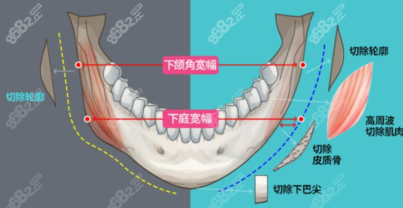 重庆松山医院面部轮廓磨骨怎么样