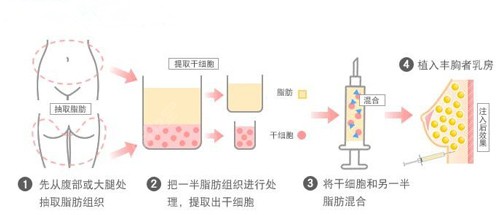 王新灿医生做脂肪隆胸的手术原理