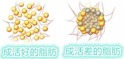 王新灿医生做脂肪隆胸后脂肪成活好