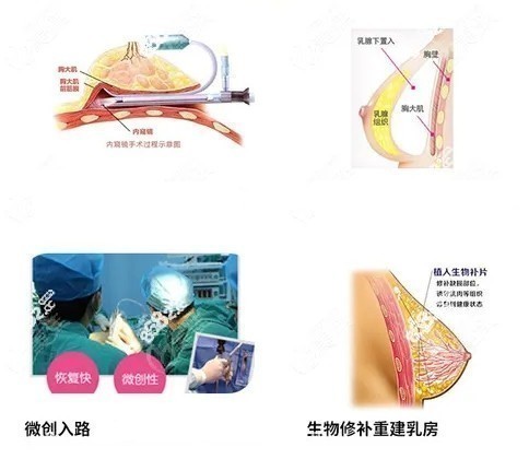 广州荔湾奥美定取出过程