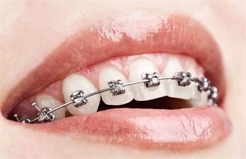 金属自锁牙套