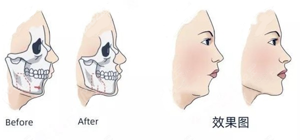 正颌手术