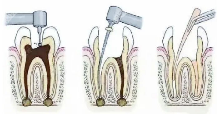 根管治療醫(yī)生