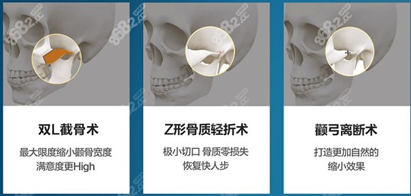 黄大勇做颧骨颧弓手术的优势