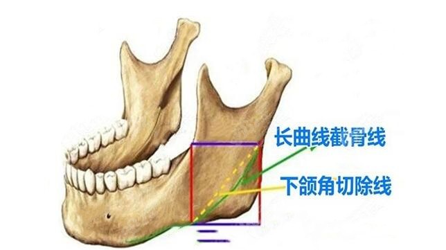 赵绛波做长曲线下颌角截骨术