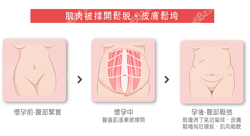 皮肤松垮可以做腹壁拉皮手术改善