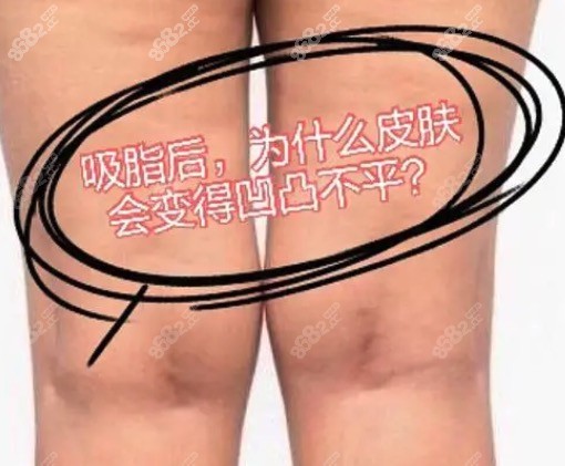 如何避免吸脂手术后皮肤松弛？