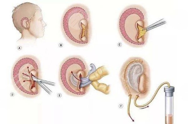 耳再造手术