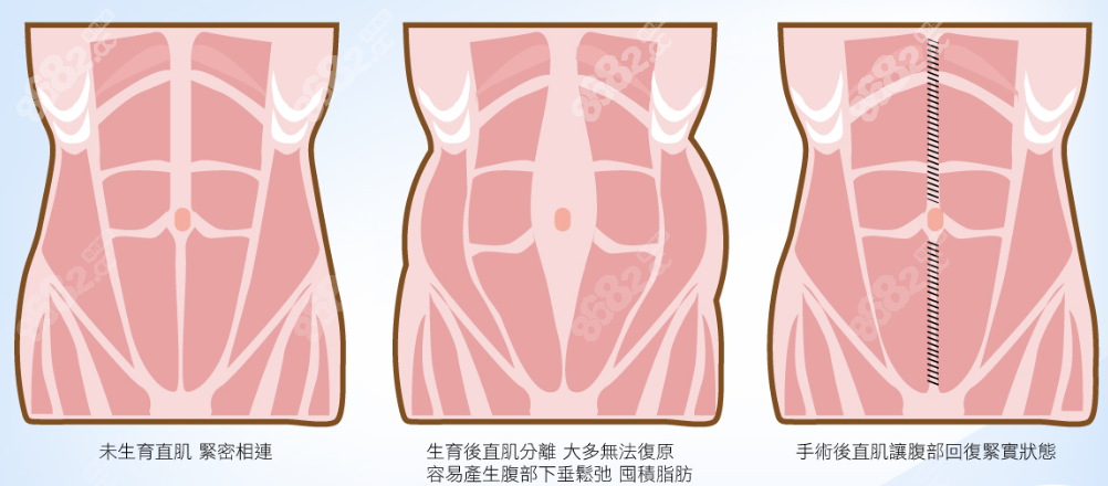 8682.cc上海腹壁拉皮手术医院哪家好