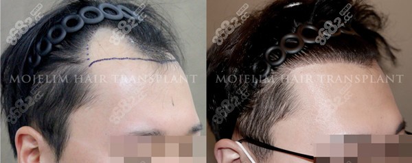 韩国非切开式植发前后对比图