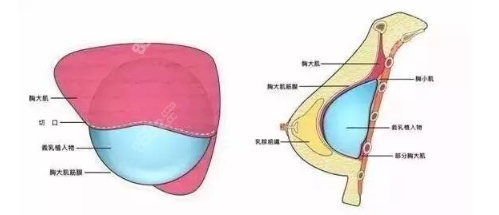 韩国假体隆胸