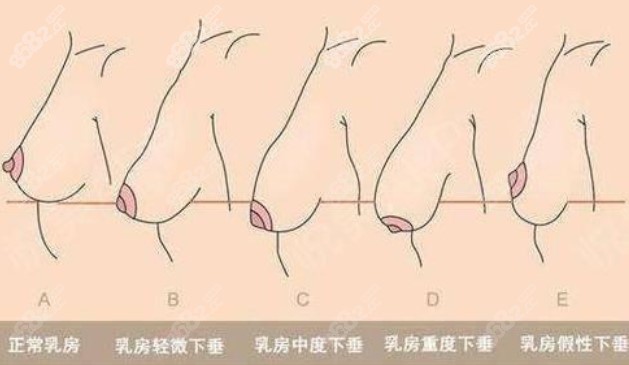 乳房下垂级别