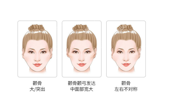 上海颧骨缩小手术医生排名www.8682.cc