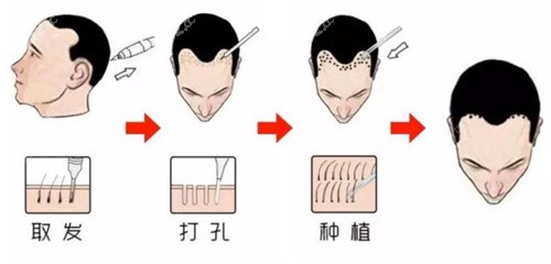 传统植发步骤图示