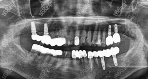 多颗种植牙术后ct照片