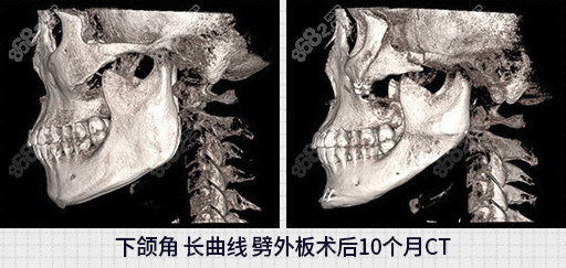 长曲线劈外板图