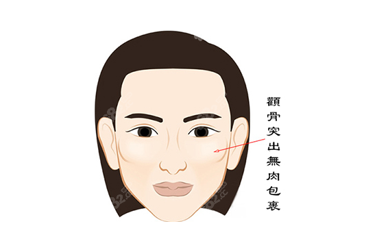 北京颧骨整形手术医生排名