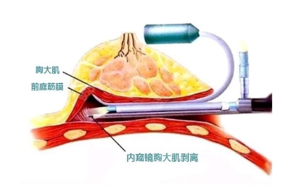 内窥镜丰胸手术