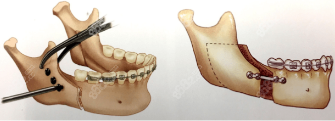 正颌正畸手术过程图示
