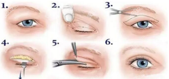 刘志刚医生双眼皮修复手术