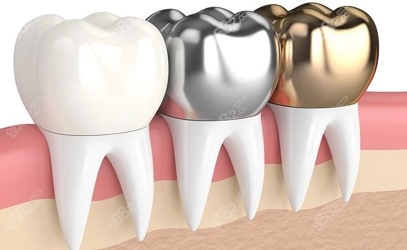 纯钛烤瓷牙和全瓷牙哪个好