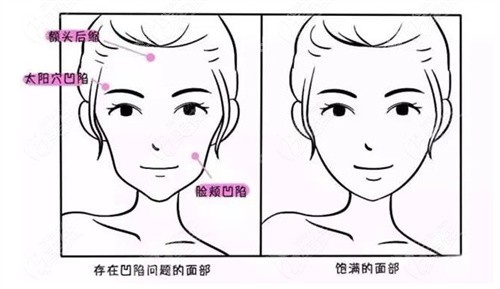 脂肪填充带来的面部饱满变化