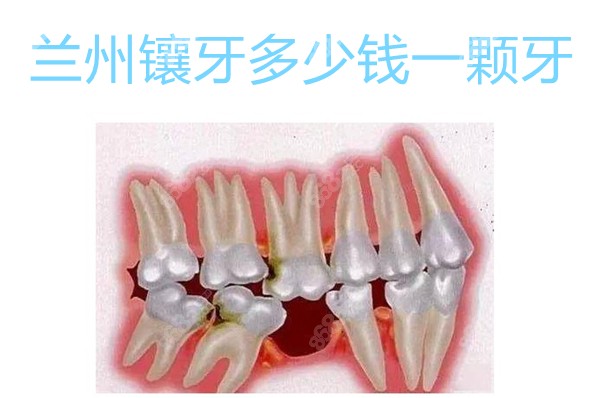 兰州镶牙多少钱一颗牙