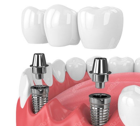 牙博士口腔种植牙价格表