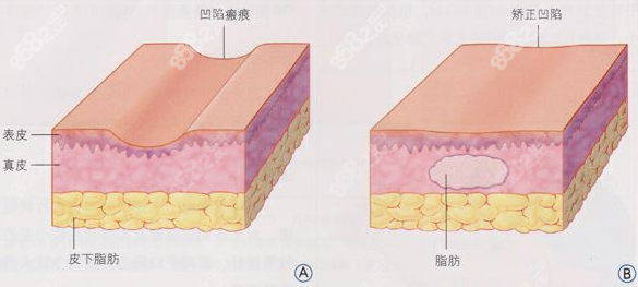 国内自体脂肪填充医院排名前十