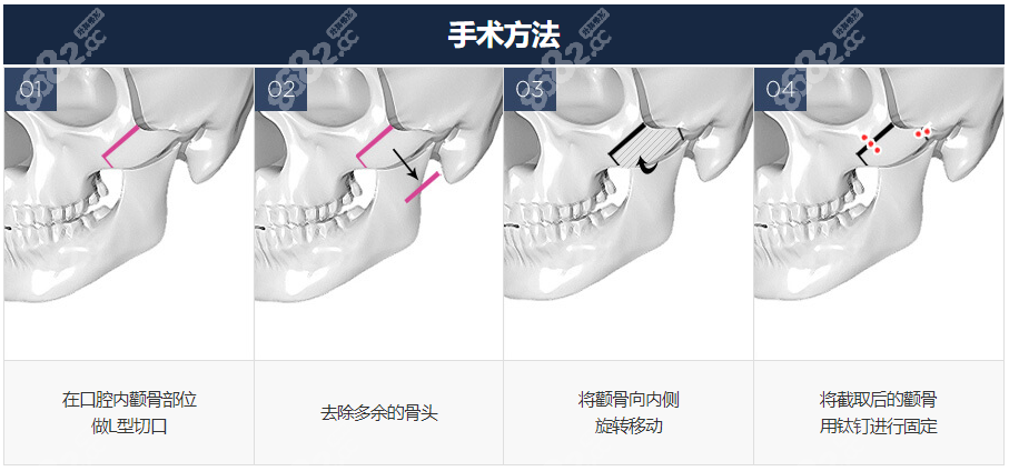 韩国gng医院颧骨内推手术过程图