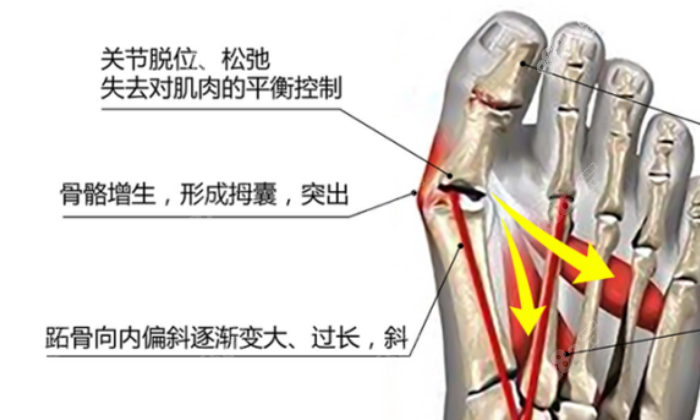 5D微孔弧拇指外翻多少钱?