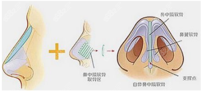 巫文云和薛轶群隆鼻