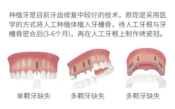 石家庄冀城口腔医院种植牙价格表