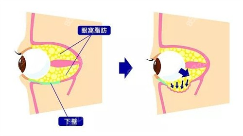 韩国必当归医院眼球突出+双眼皮技术成熟