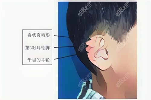 宝宝耳廓畸形-Stahl's 耳图片.jpg