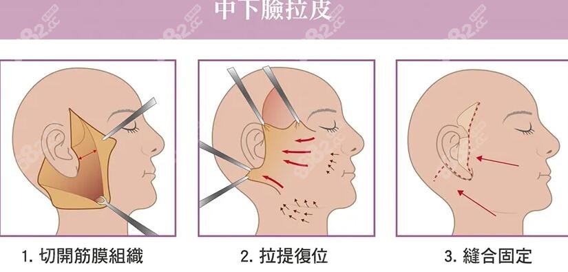 韩国拉皮手术好的医院